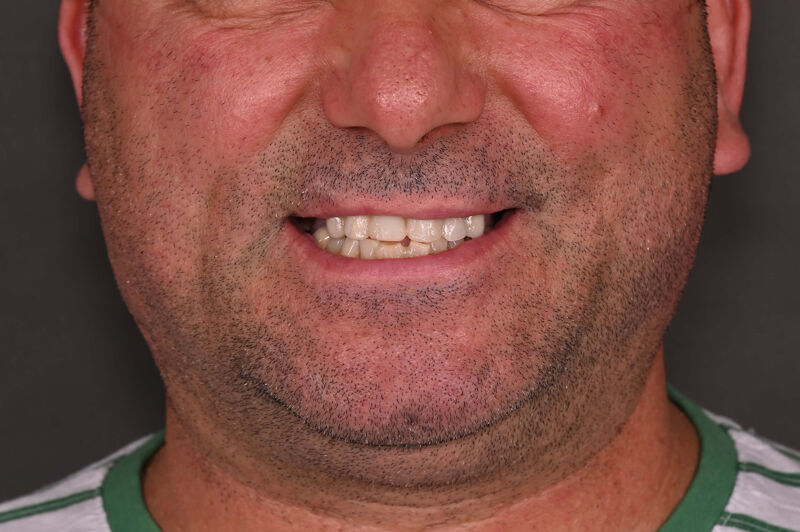 Zâmbet lateral stanga_înainte